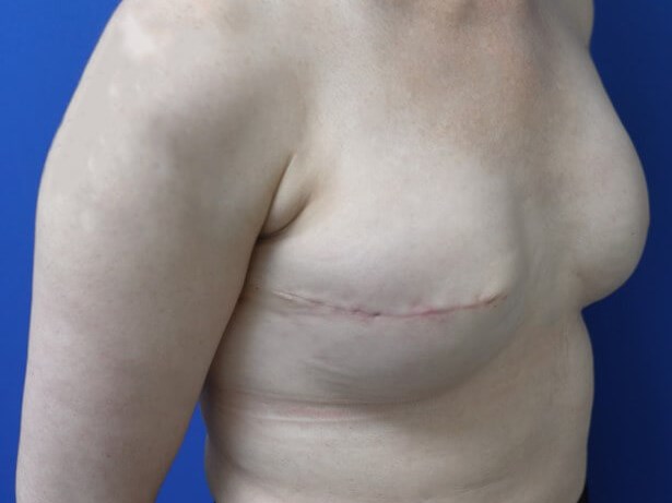 Breast Reconstruction After