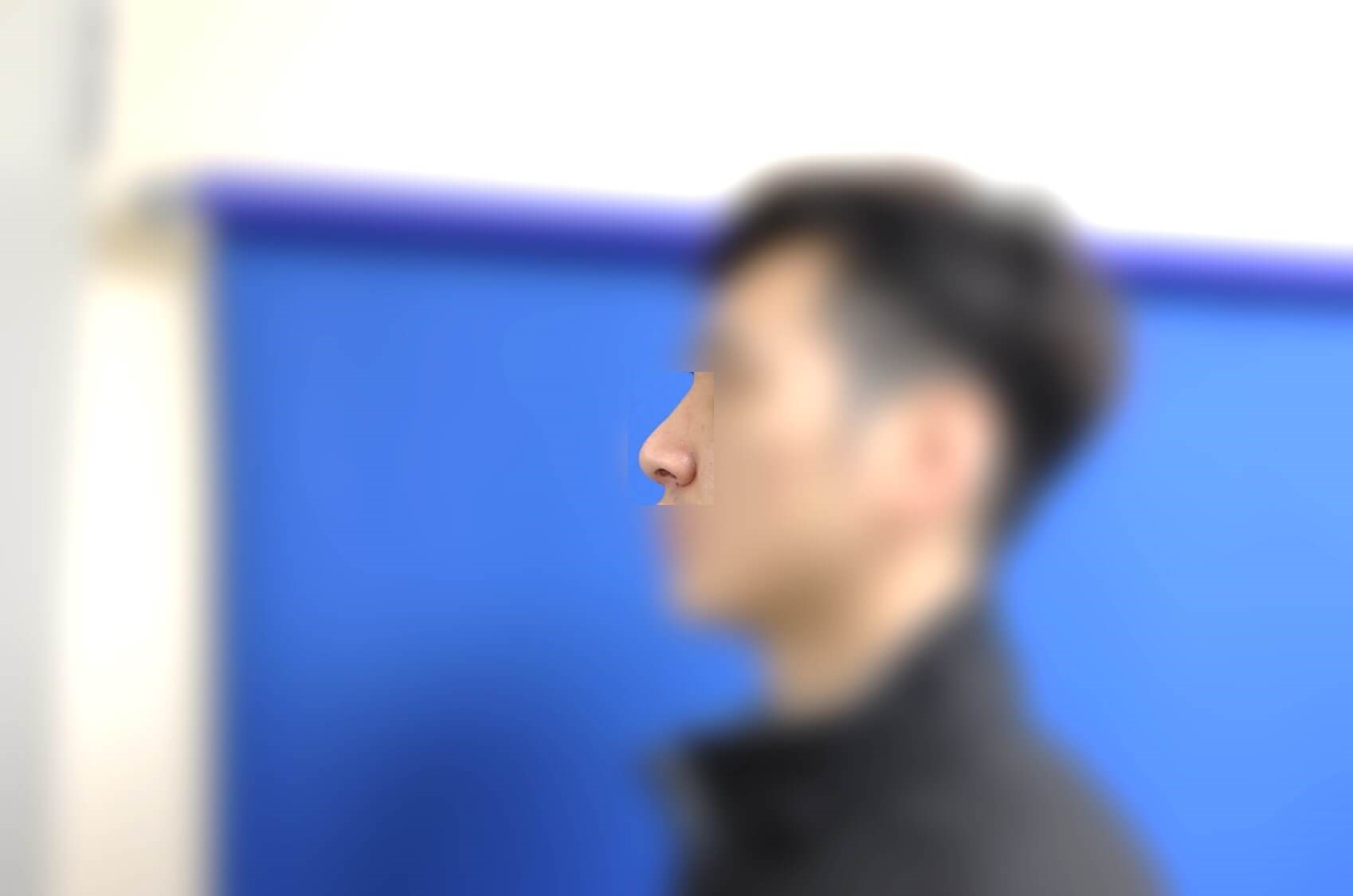 Rhinoplasty After