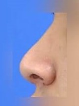 Rhinoplasty After