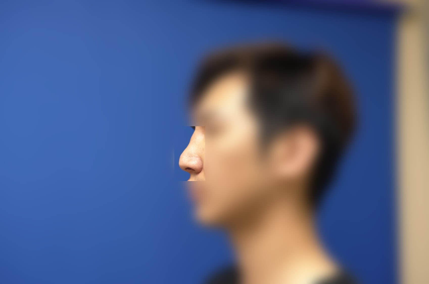 Rhinoplasty Before