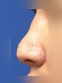 Rhinoplasty Before