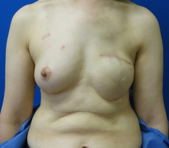 Breast Reconstruction Before