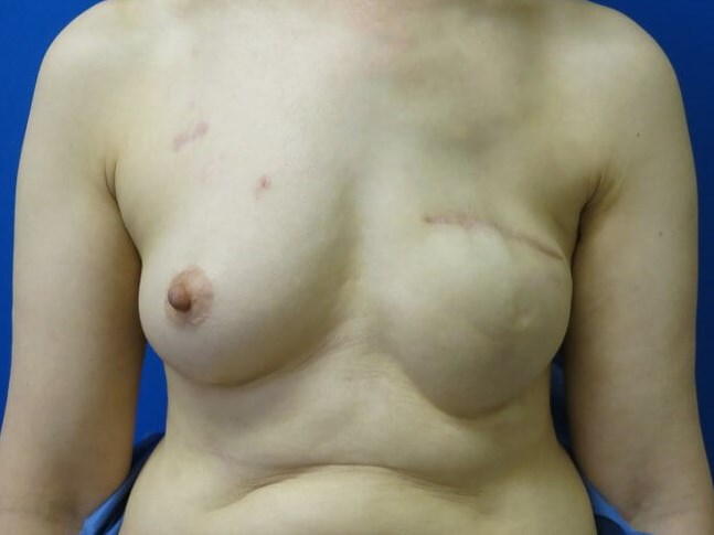 Breast Reconstruction Before