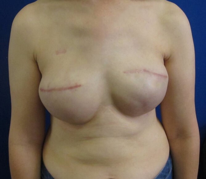 Breast Reconstruction After