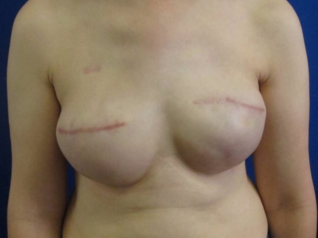 Breast Reconstruction After
