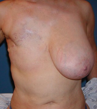 Breast Reconstruction Before
