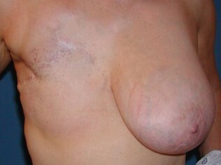 Breast Reconstruction Before