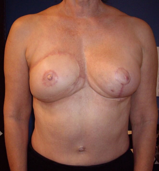 Breast Reconstruction After