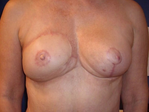 Breast Reconstruction After