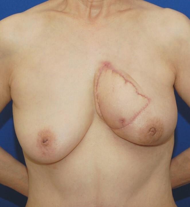 Breast Reconstruction After