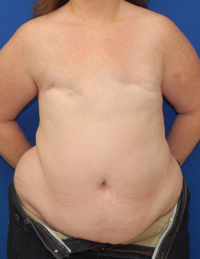 Breast Reconstruction Before