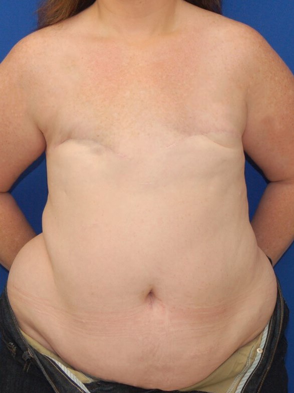 Breast Reconstruction Before