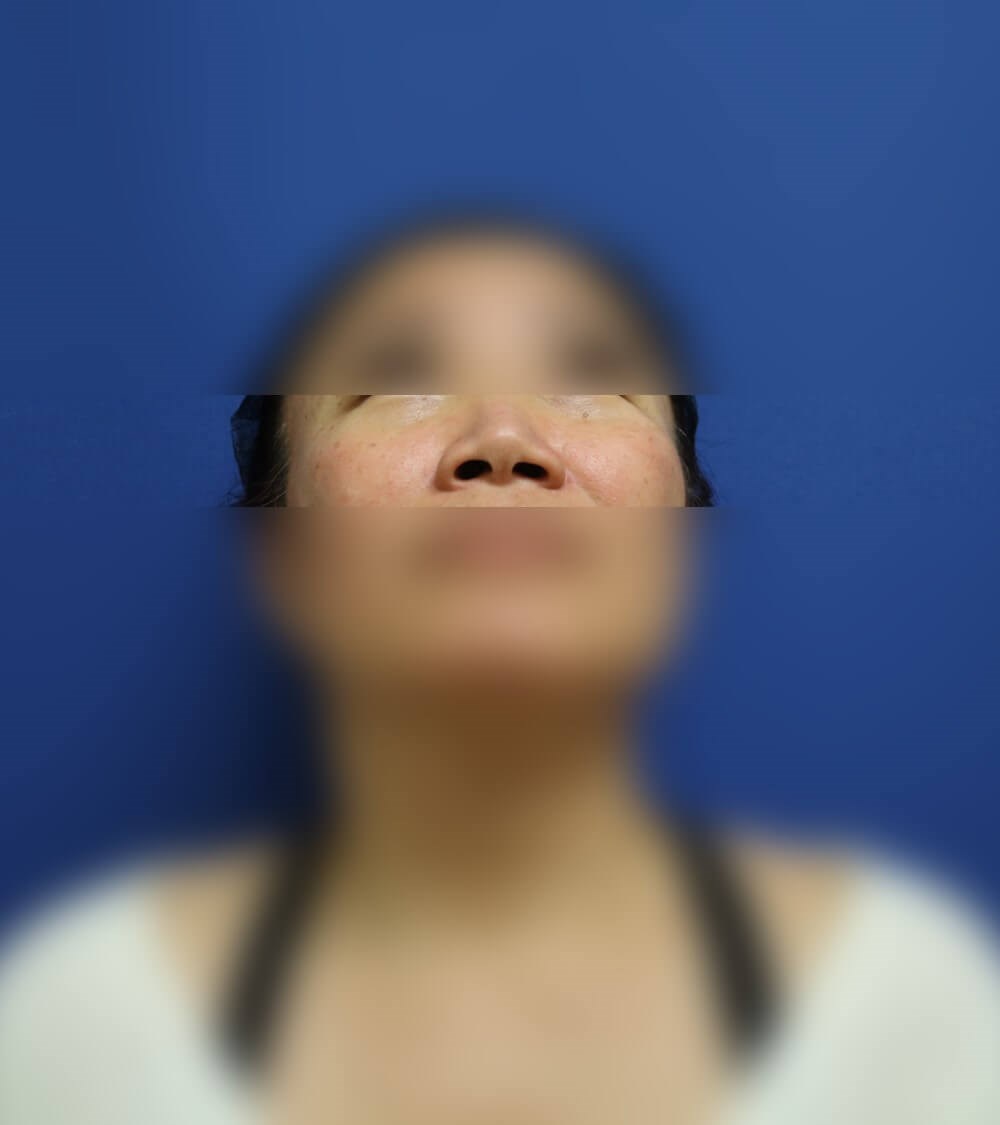 Rhinoplasty Before