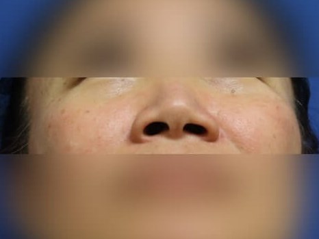 Rhinoplasty Before
