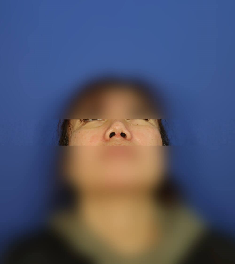 Rhinoplasty After