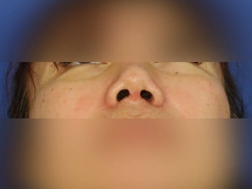 Rhinoplasty After