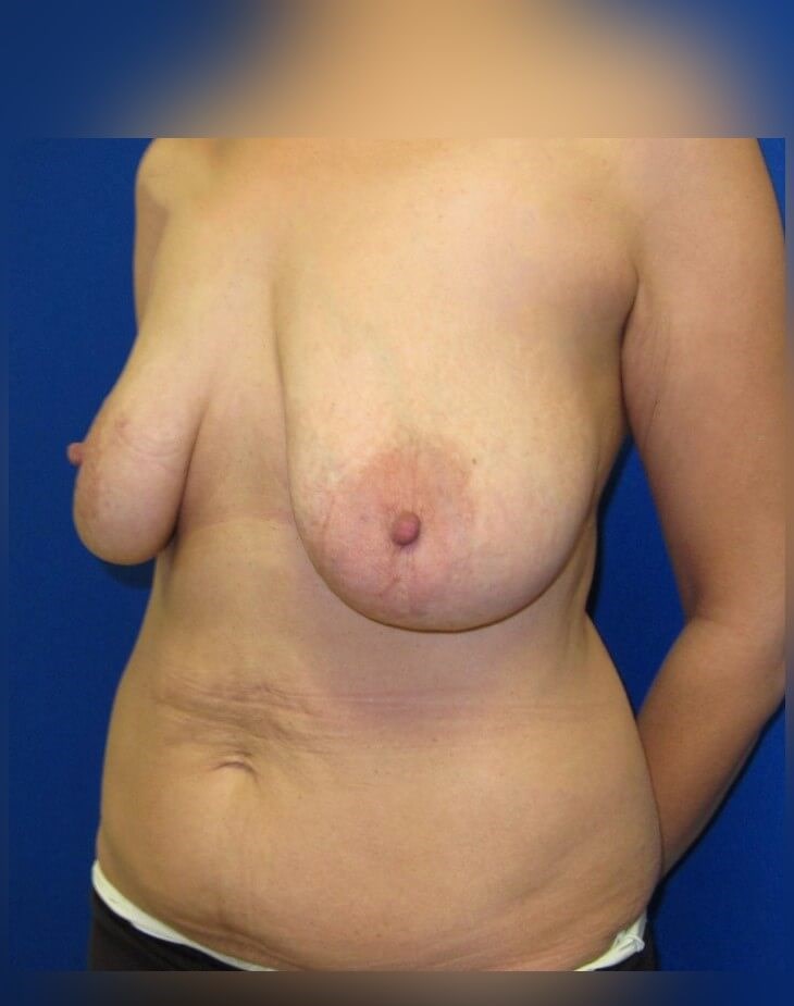 Breast Reconstruction Before