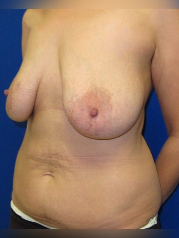 Breast Reconstruction Before