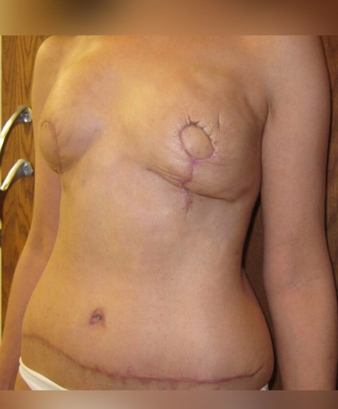 Breast Reconstruction After