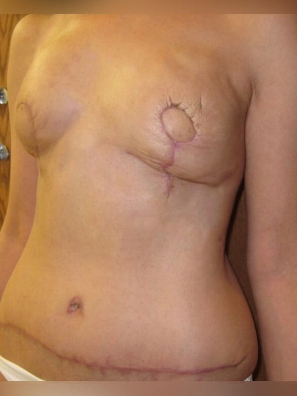 Breast Reconstruction After
