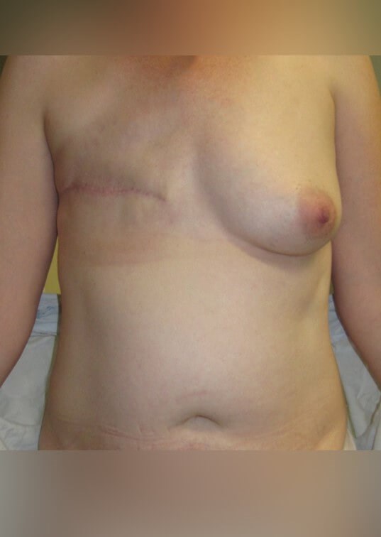 Breast Reconstruction Before