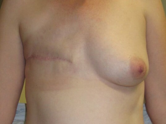 Breast Reconstruction Before