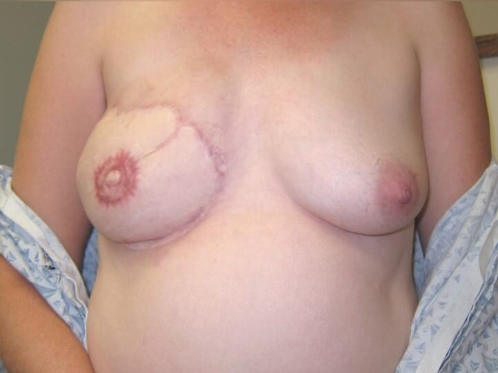 Breast Reconstruction After