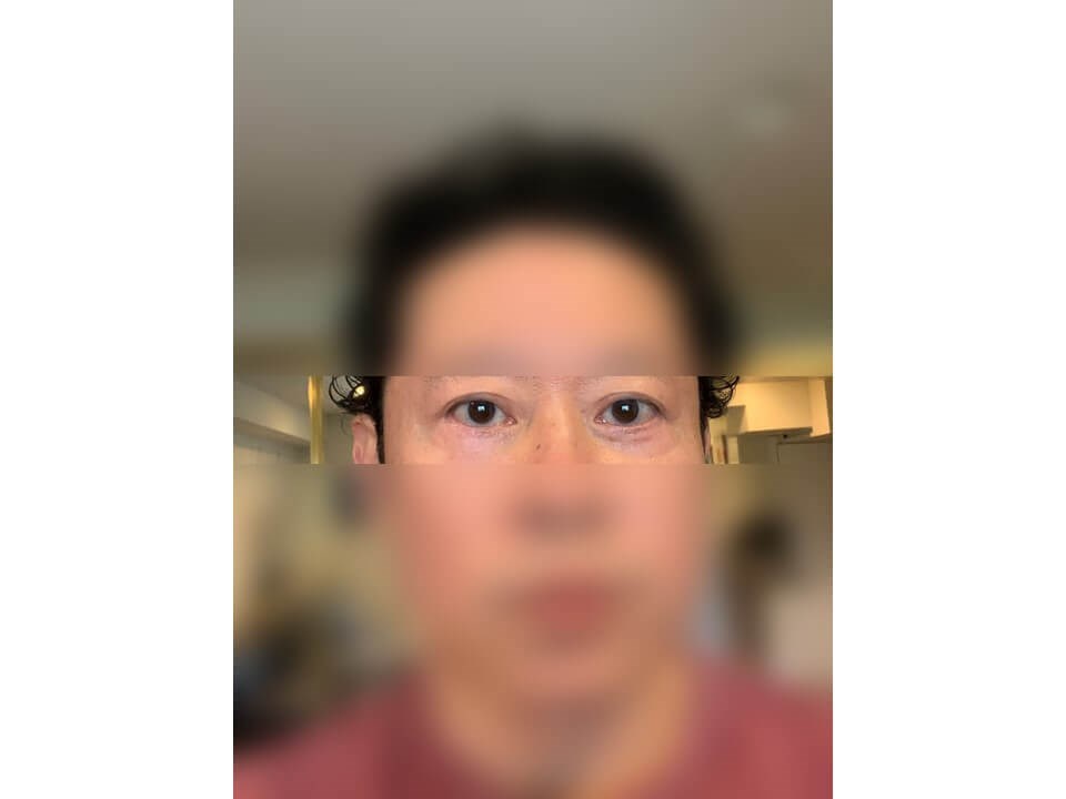 Lower Eyelid Surgery After