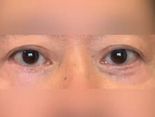 Lower Eyelid Surgery After