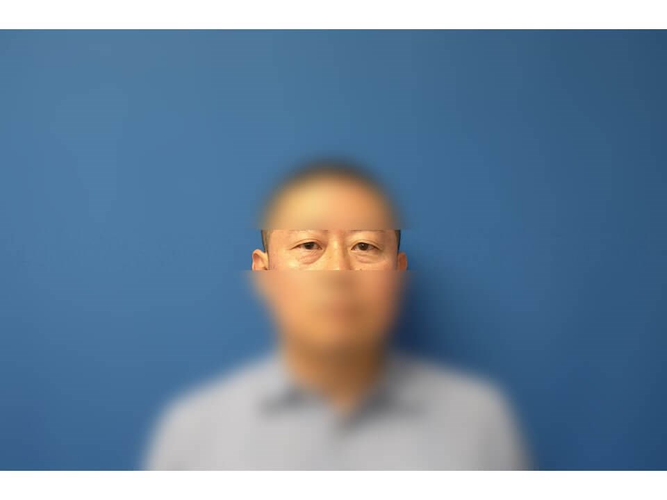 Lower Eyelid Surgery Before