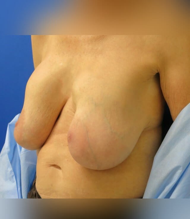 Breast Lift, Mastopexy Before
