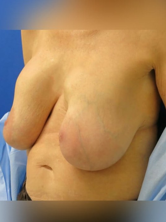Breast Lift, Mastopexy Before