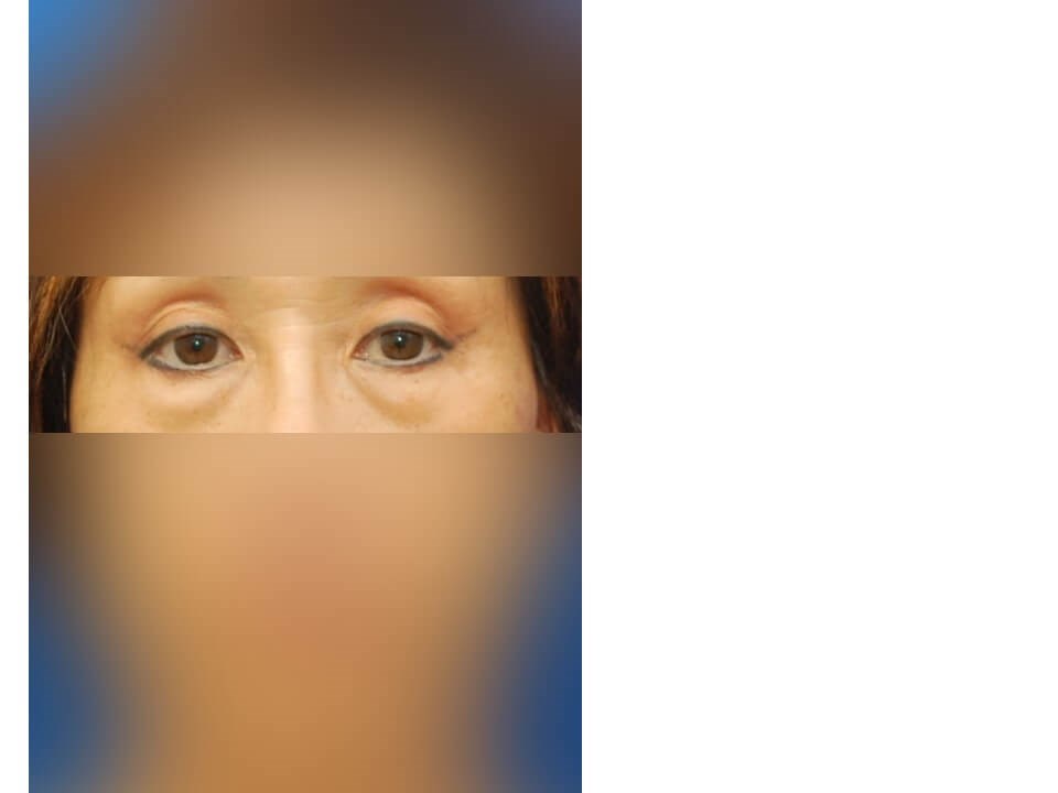 Lower Eyelid Surgery Before