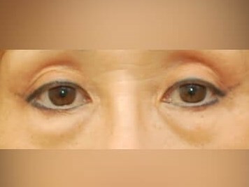 Lower Eyelid Surgery Before