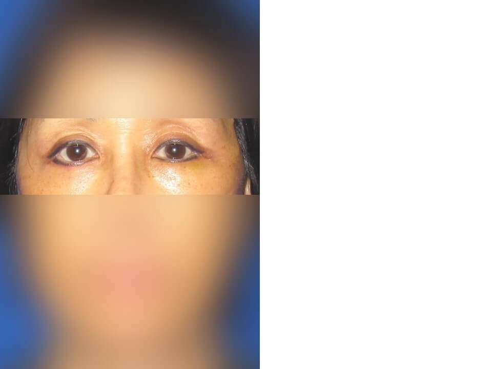 Lower Eyelid Surgery After