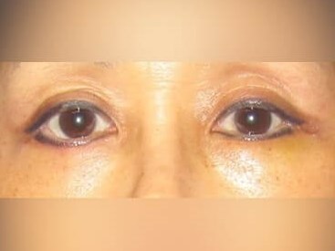 Lower Eyelid Surgery After