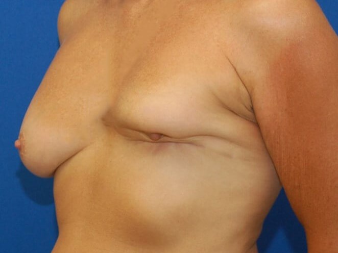 Breast Reconstruction Before