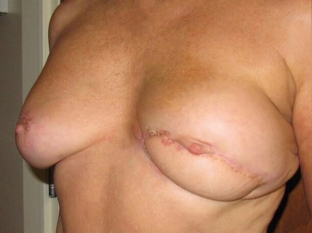 Breast Reconstruction After