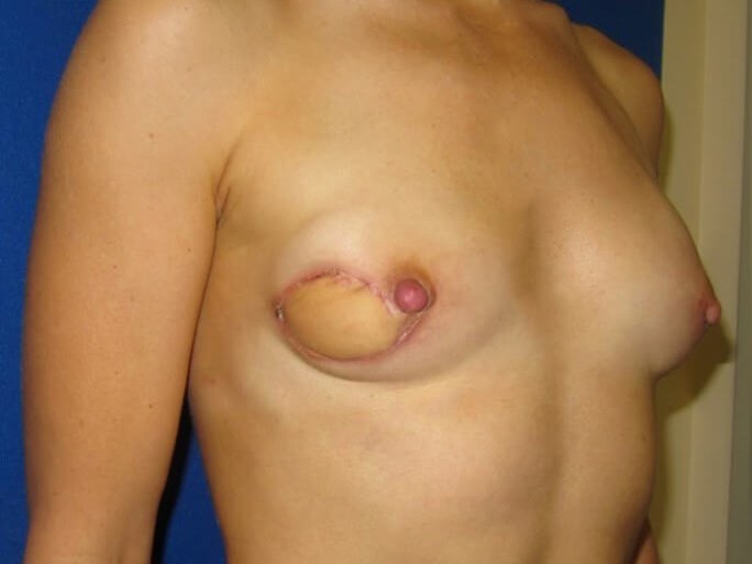 Breast Reconstruction After