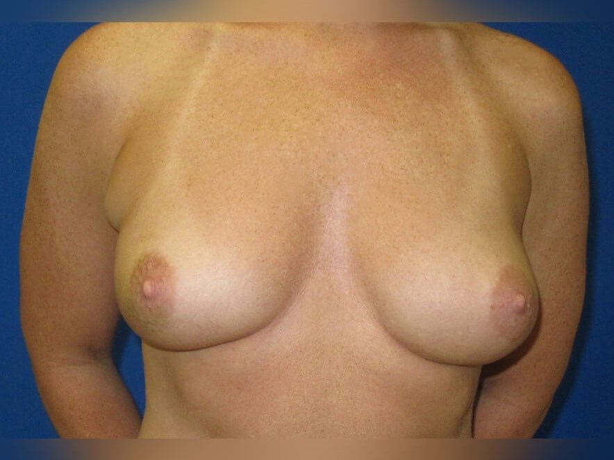 Breast Reconstruction Before