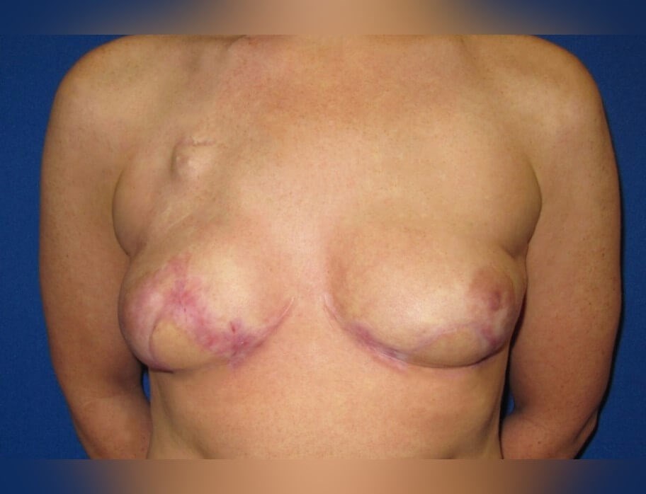 Breast Reconstruction After