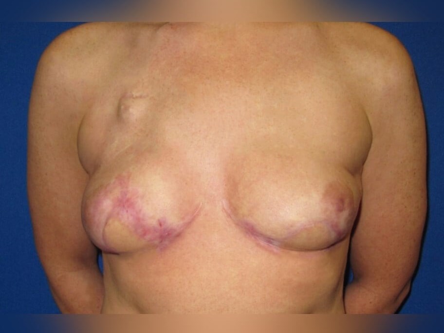Breast Reconstruction After
