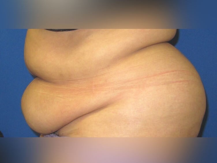 Tummy Tuck Before