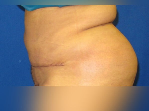 Tummy Tuck After