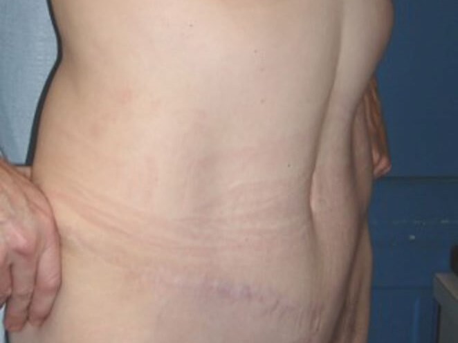 Tummy Tuck After