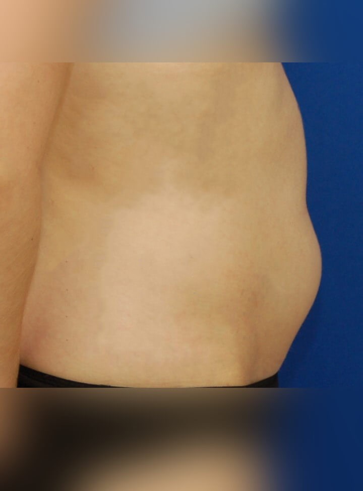 Tummy Tuck Before