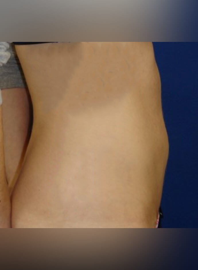 Tummy Tuck After