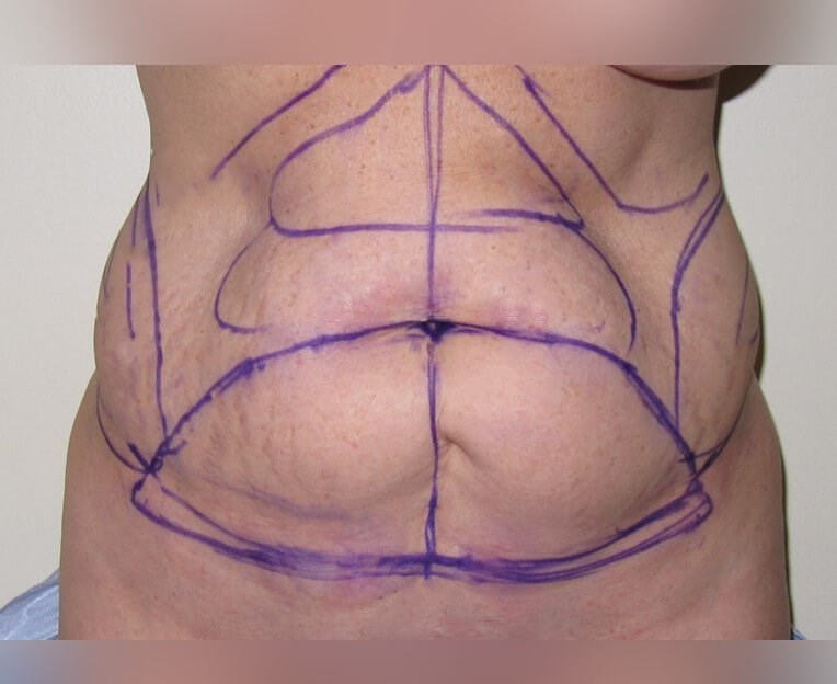 Tummy Tuck Before