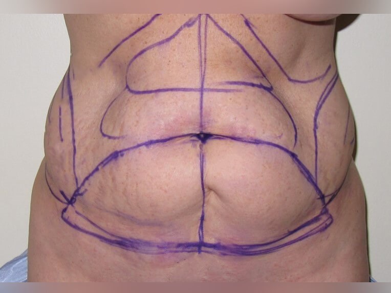 Tummy Tuck Before