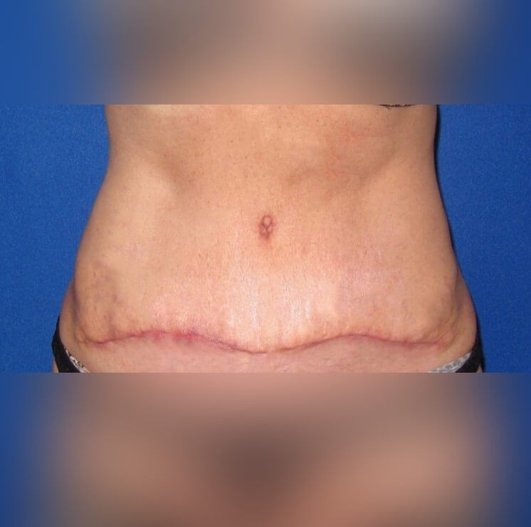 Tummy Tuck After
